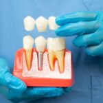 Dental implant model showing crown placement and implant restoration process