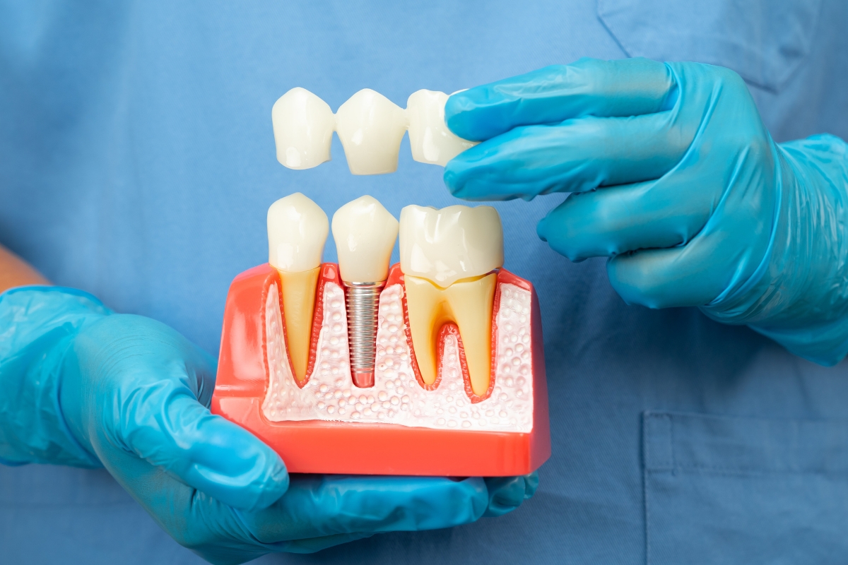 Dental implant model showing crown placement and implant restoration process